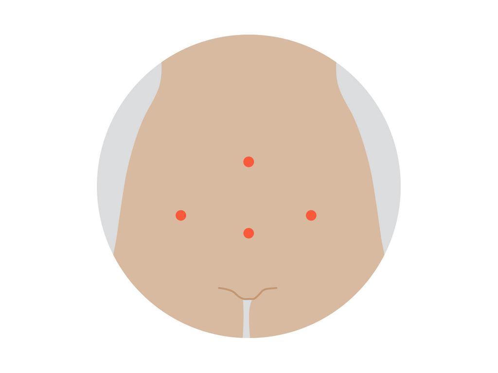 Keyhole surgery section image