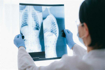 Lung cancer screening image